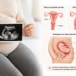 Útero retrovertido embarazo ilustración comparativa con ecografía y posición del útero